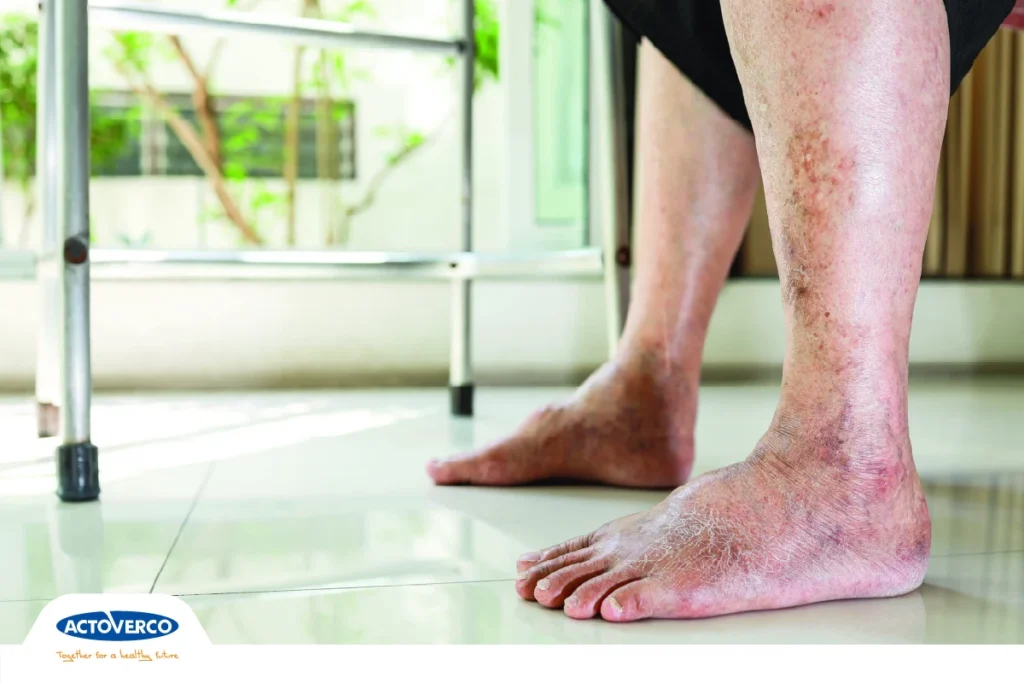 زخم پای دیابتی