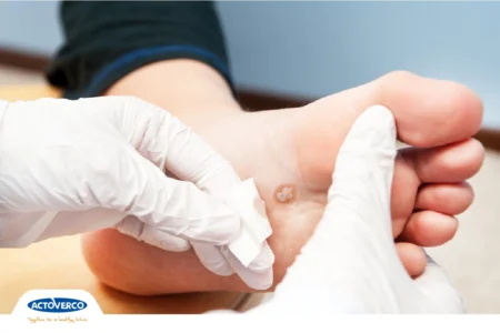 زخم پای دیابتی