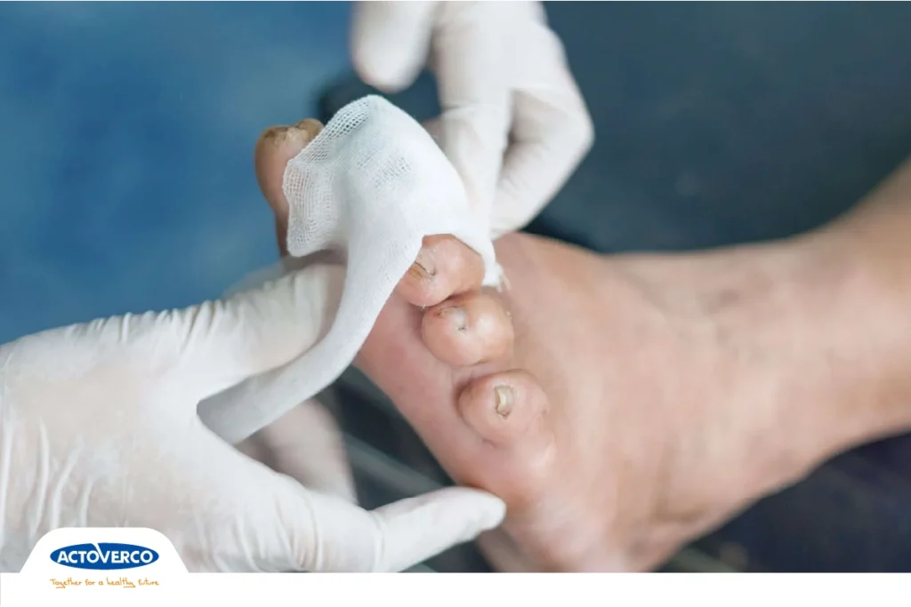 زخم پای دیابتی