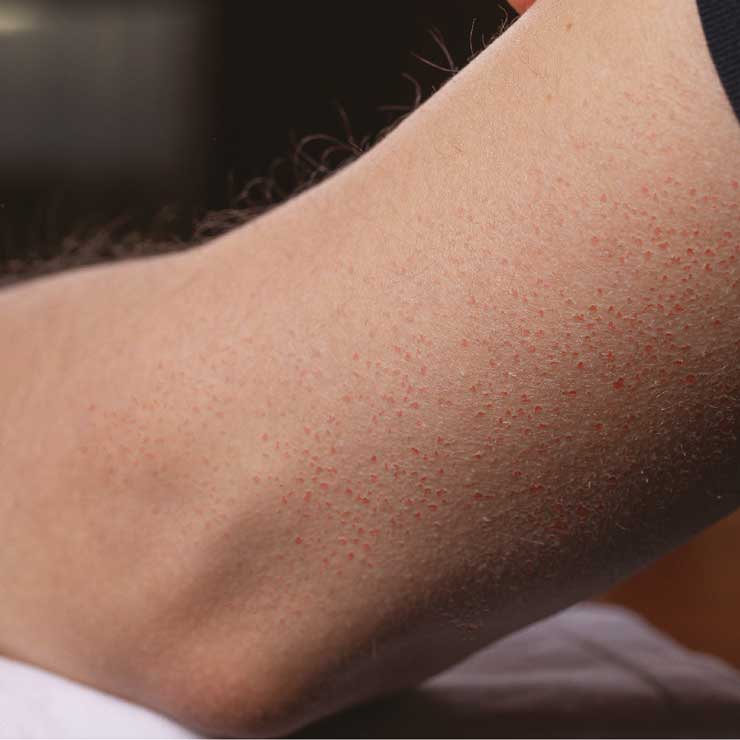 keratosis-pilaris