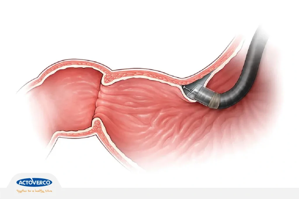 گاستروپارزی