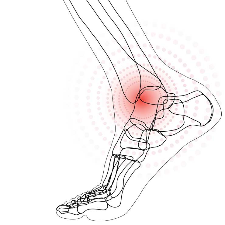 Osteoarthritis