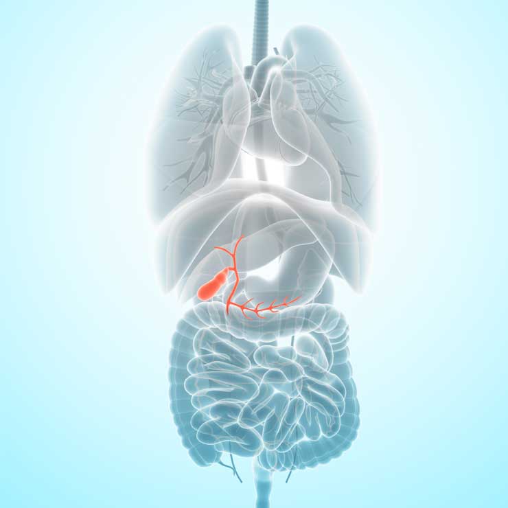 Gallstones