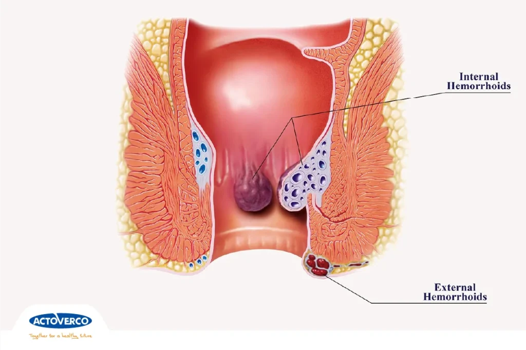 خونریزی مقعدی