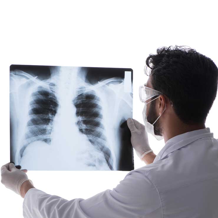 lung-cancer