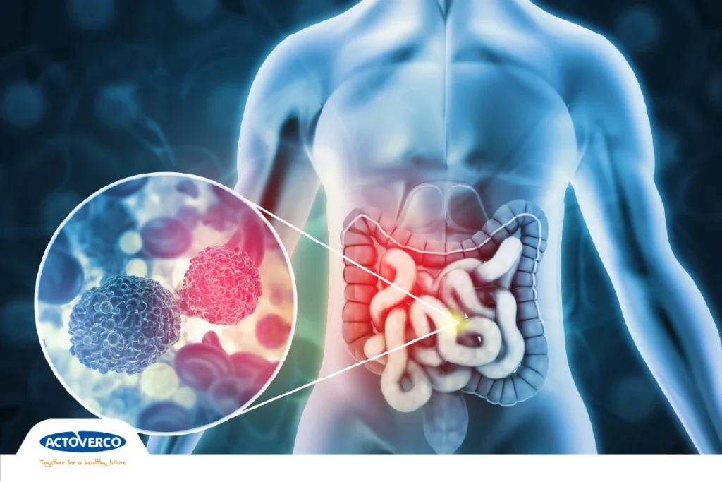 سرطان روده بزرگ