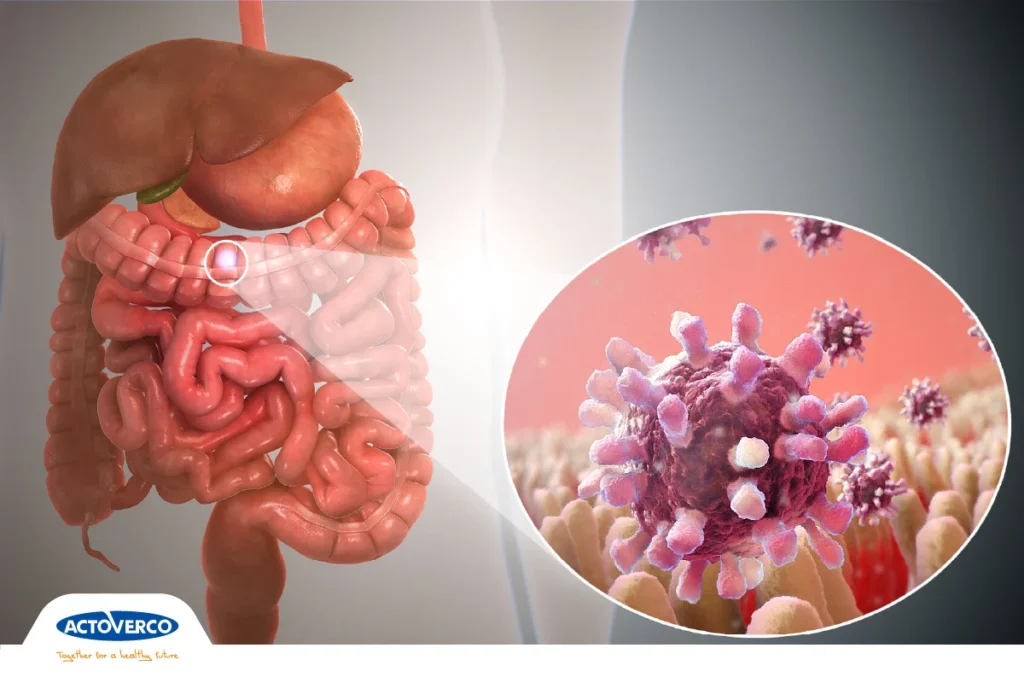 گاستروانتریت