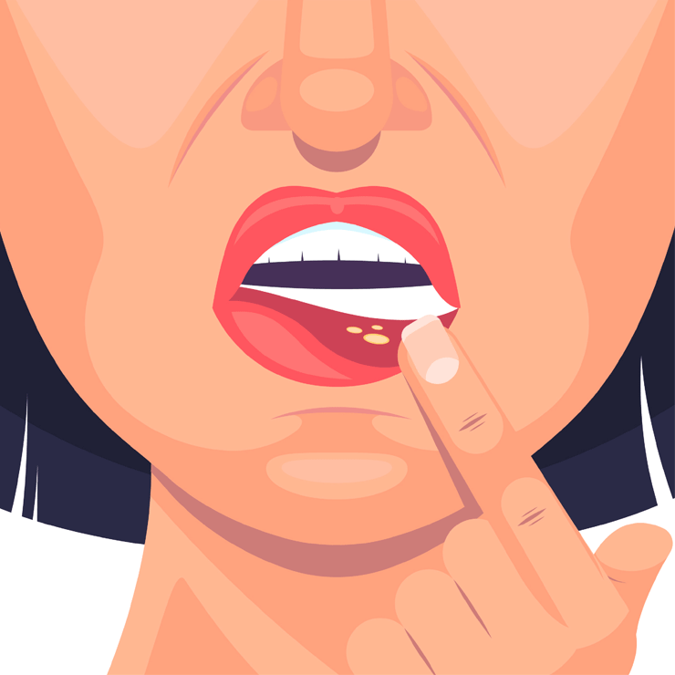 Mouth-Sores