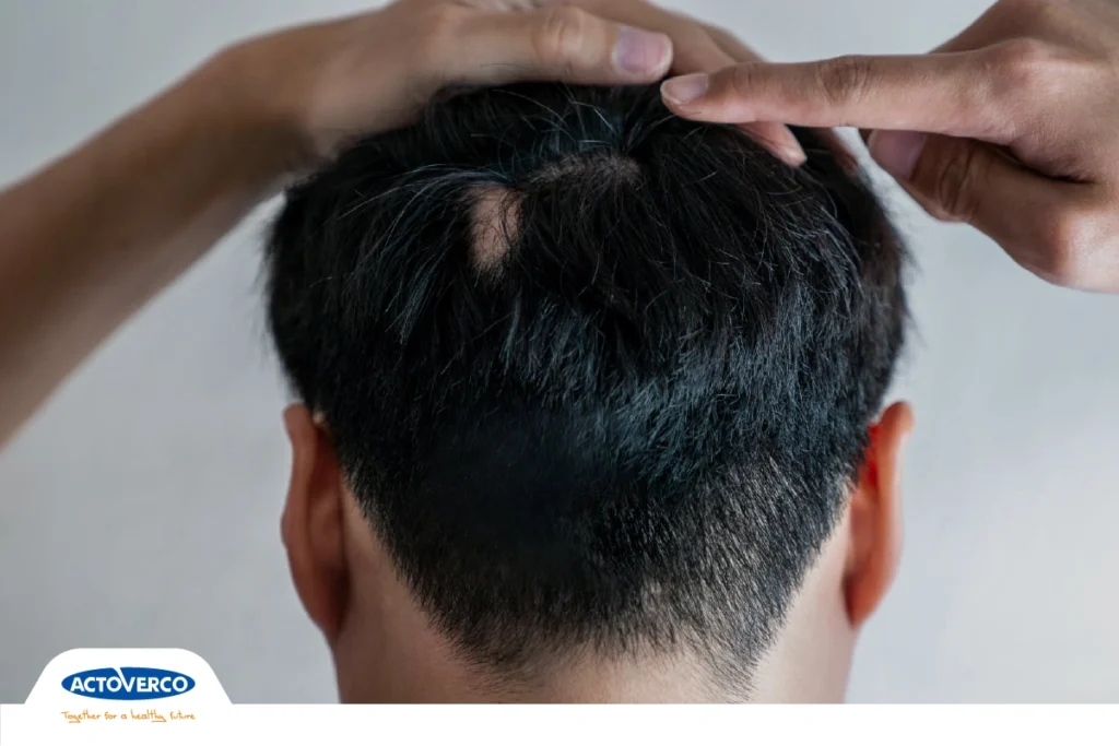 اختلال کندن مو