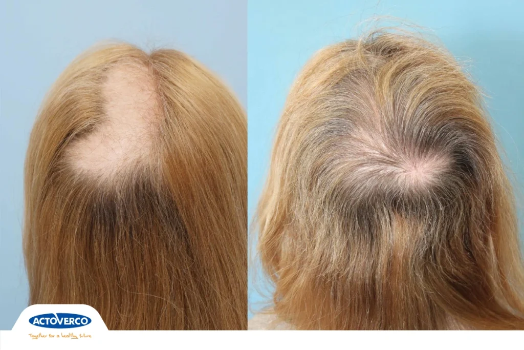 اختلال کندن مو