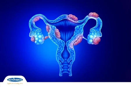 اندومتریوز