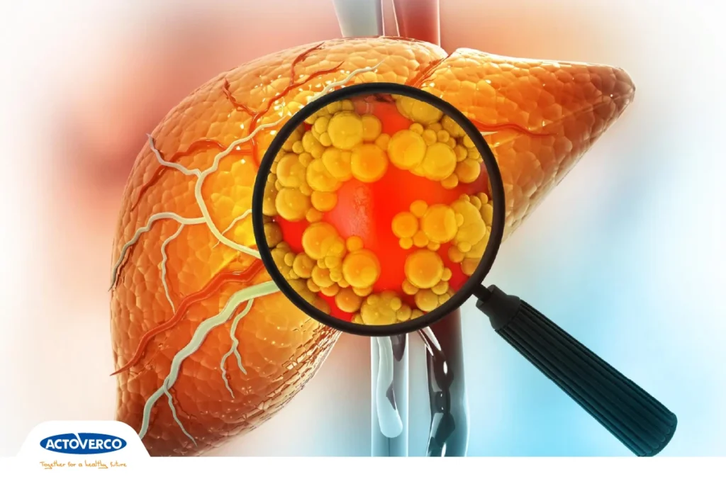علائم کبد چرب