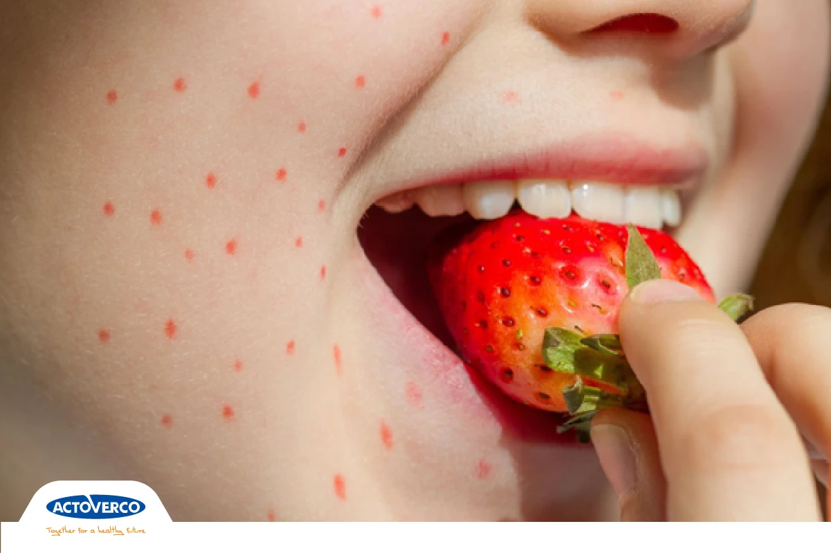 آلرژی مواد غذایی