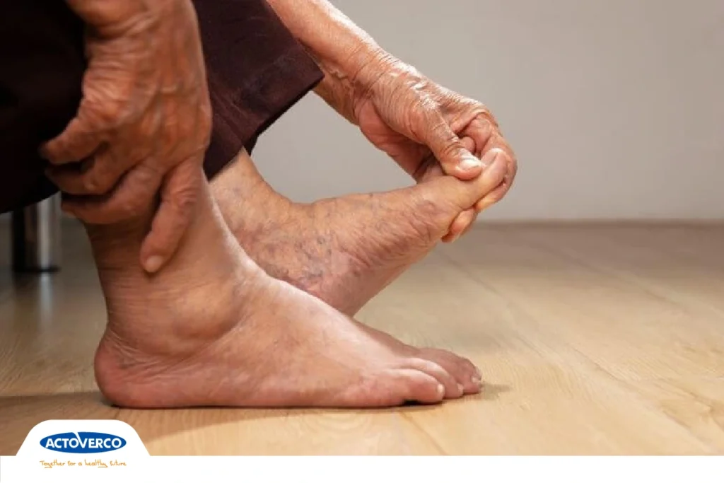 نوروپاتی دیابتی