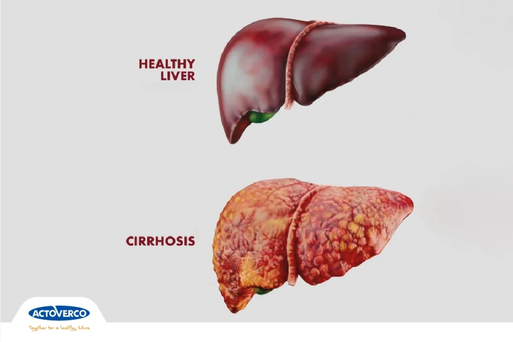 آنسفالوپاتی
