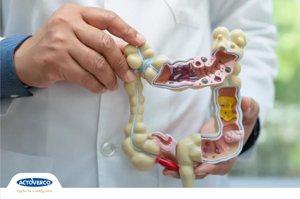 روده تحریک پذیر