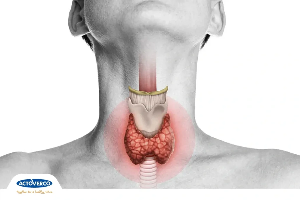 تکم کاری تیروئید