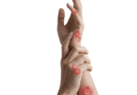 Dermatitis