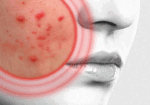 Lichen-planus