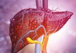 fatty-liver