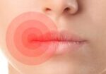 herpes
