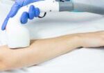 hirsutism